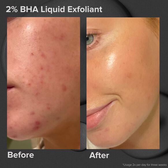 Paula's Choice Skin Perfecting2% BHA Liquid Exfoliant 30ml
