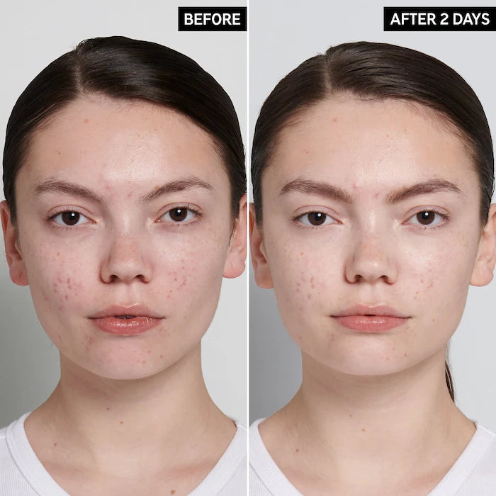 The INKEY List Succinic Acid Acne Treatment