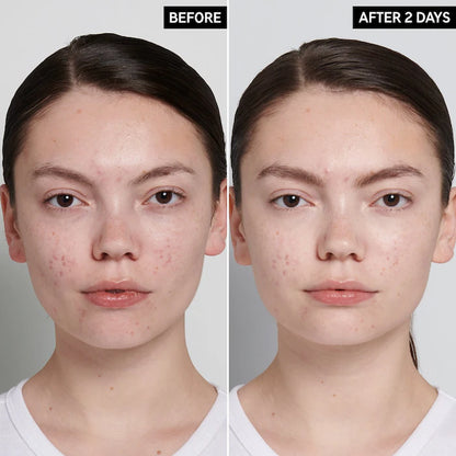 The INKEY List Succinic Acid Acne Treatment